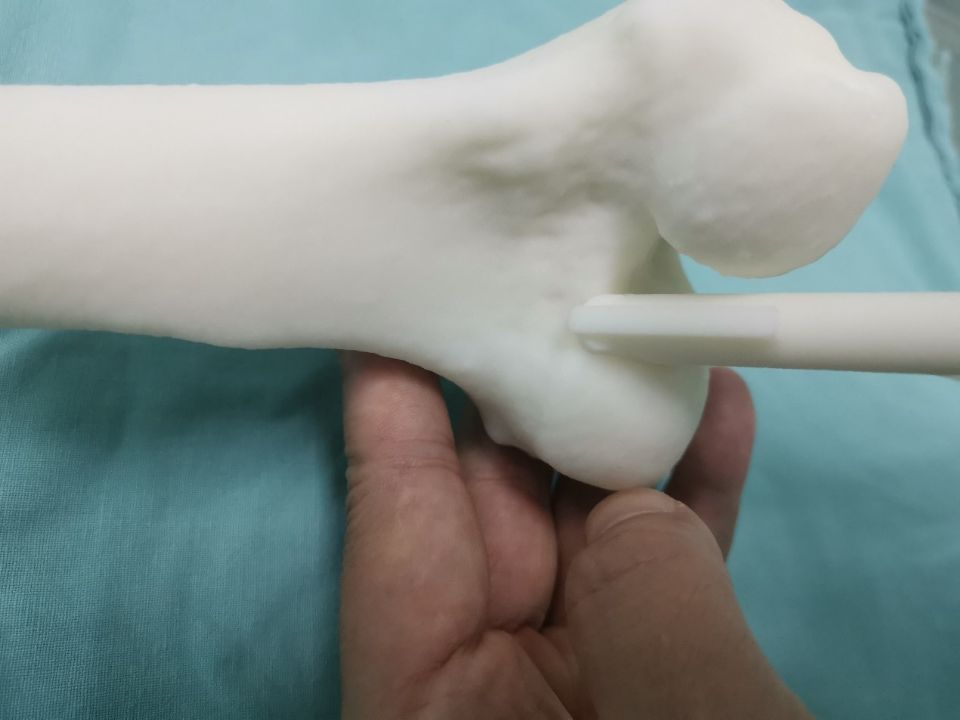 术前，医生用3d打印的膝关节模型模拟手术。均为长沙晚报通讯员 梁辉供图