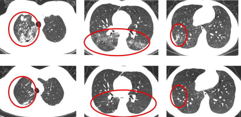 治疗6月前后患者胸部ct检查比较(上排为治疗前,下排为治疗后),可见肺内病灶明显吸收,空洞已闭合。 通讯员供图 治疗6月前后患者胸部ct检查比较(上排为治疗前,下排为治疗后),可见肺内病灶明显吸收,空洞已闭合。 通讯员供图