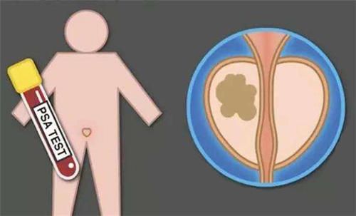 50岁以上的男性需要每年做前列腺相关检查，特别是psa（前列腺特异抗原）检查。