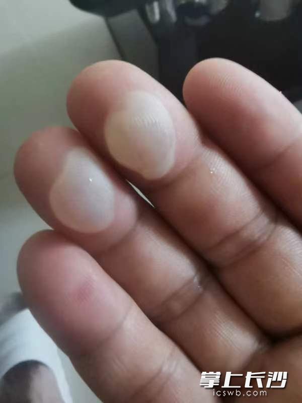 因使用二氧化碳灭火器，向庆手上起了水泡。受访者 供图