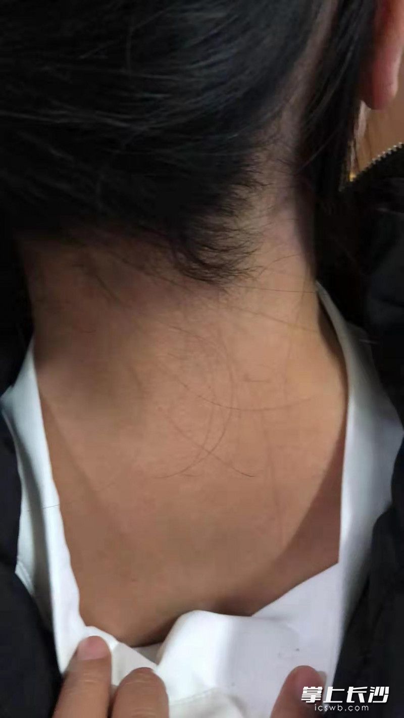 张女士因对火锅过敏而出现瘙痒性的荨麻疹。